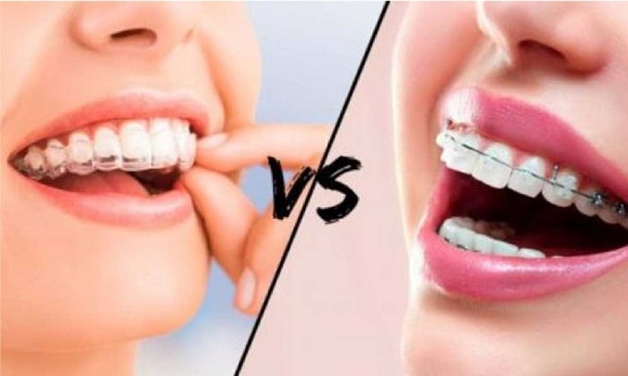 Dental Braces vs. Aligners