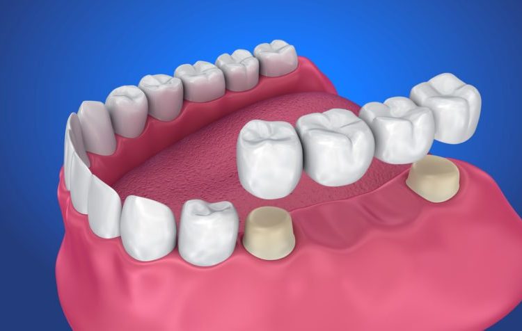 Unveiling the Beauty and Strength of Zirconia Crowns