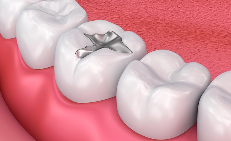 Dental Fillings Treatment