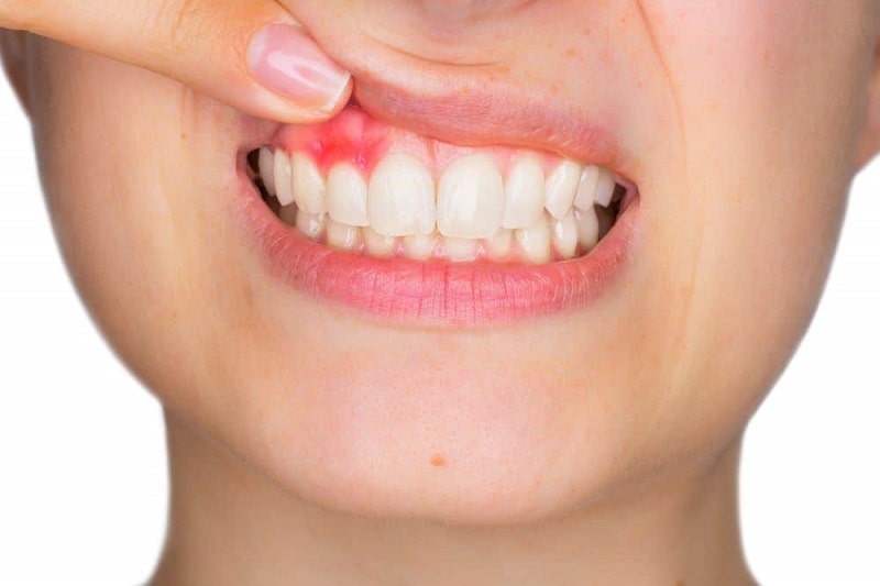 Gum Surgery Treatment
