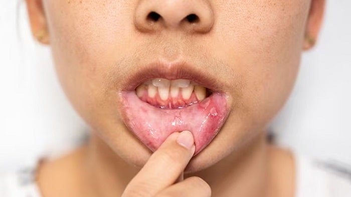 Oral Precancerous