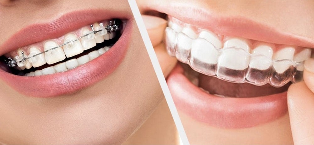 Best Braces & Aligners Dentistry
