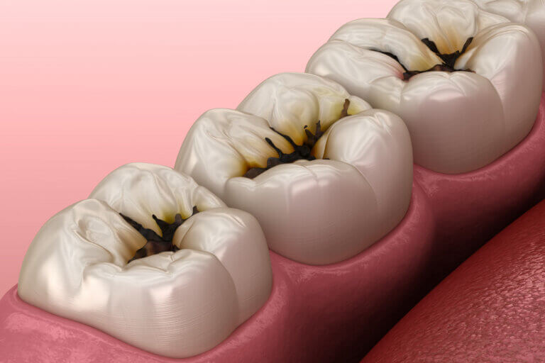 Dental Decay Treatment